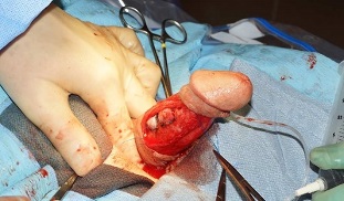 chirurgie d'agrandissement du pénis