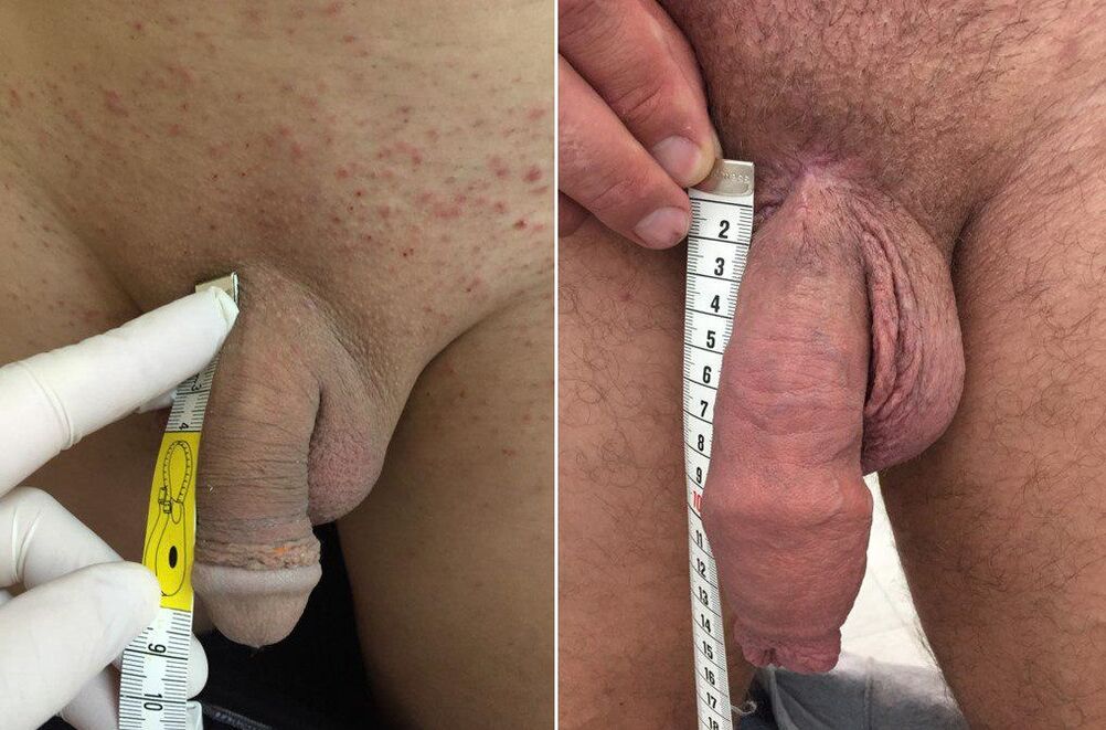 avant et après l'agrandissement opératoire du pénis